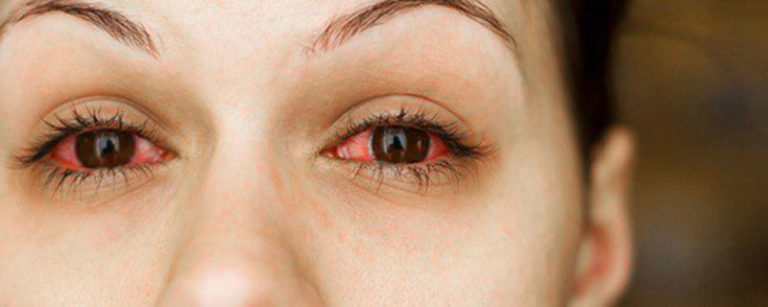 Conjuntivitis Alérgica Oftalmología Avanzada