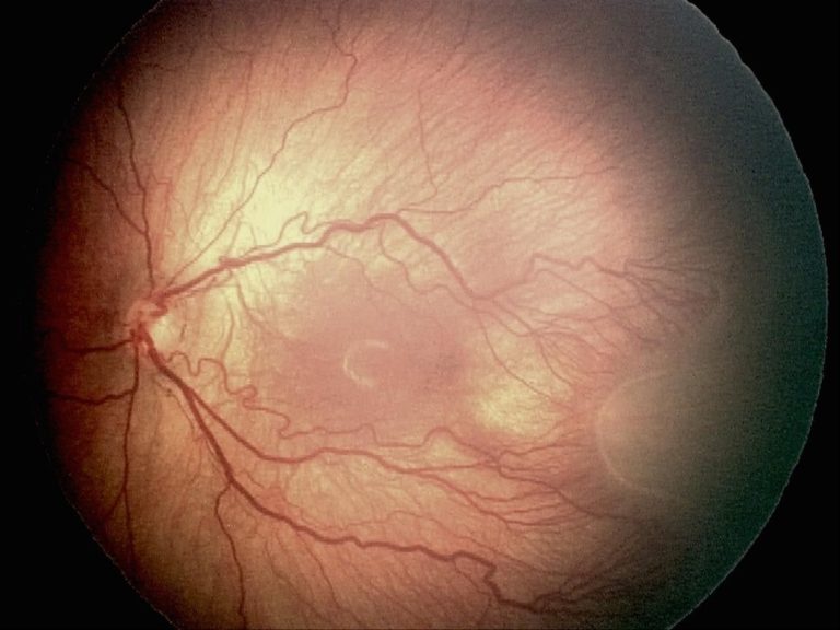 Retinopatía Del Prematuro | Oftalmología Avanzada